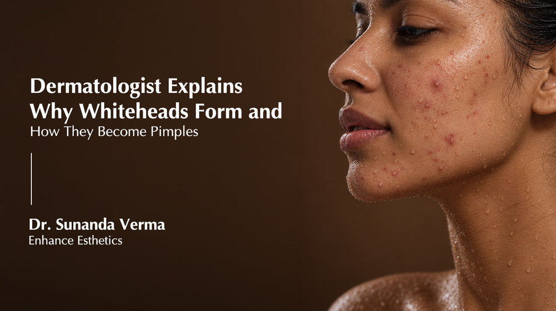 Dermatologist Explains Why Whiteheads Form and How They Become Pimples