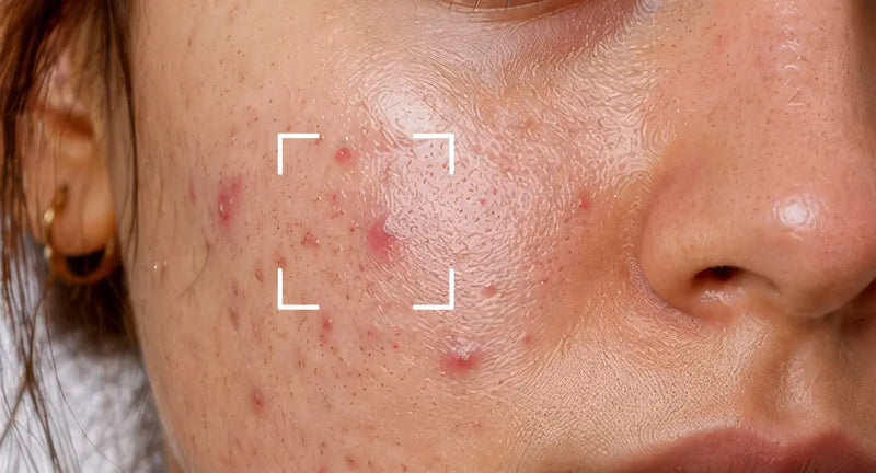 Acne